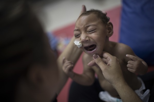 Vrus da zika causa microcefalia em bebs, entre outras malformaes